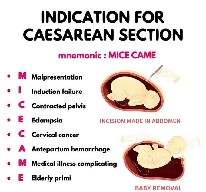 C-Section-Indications