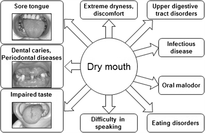 Cause of Xerostomia