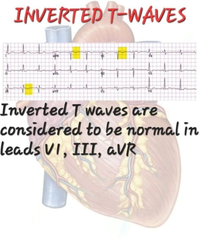 Inverted T Wave