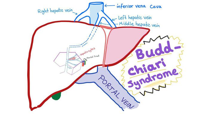 Budd-Chiari Syndrome