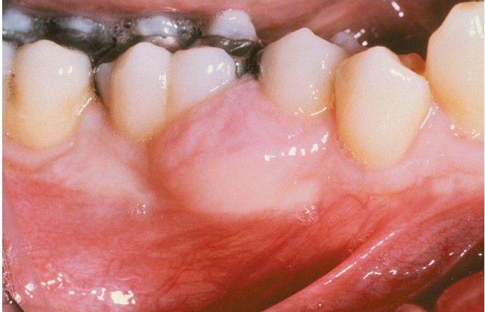 Peripheral Odontogenic Fibroma