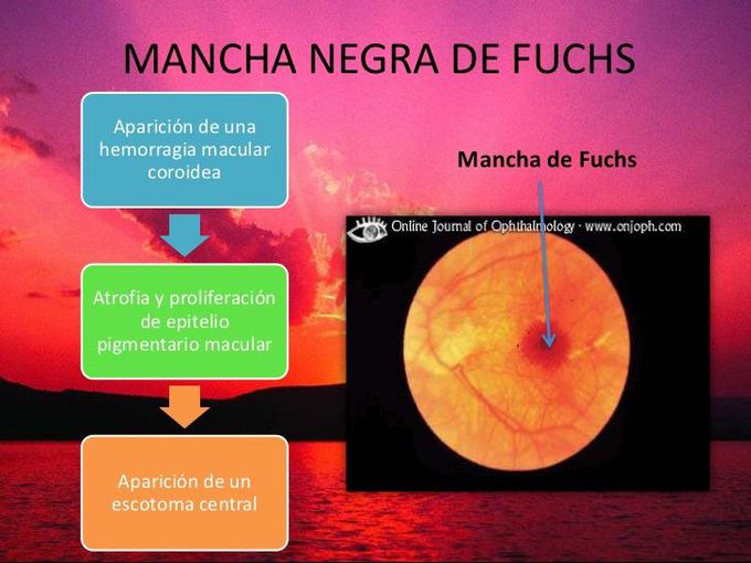 Mancha de Fuchs