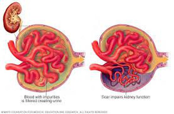 Glomerulosclerosis