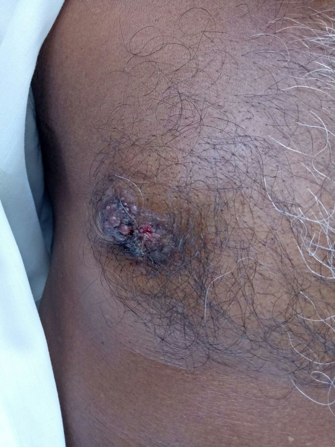 Carcinoma male breast....... Ulcerated....