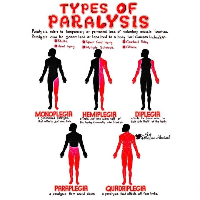 Types of paralysis