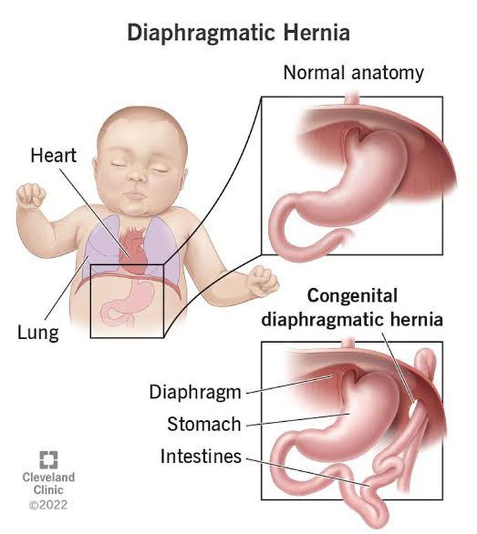 Diaphragmatic Hernia