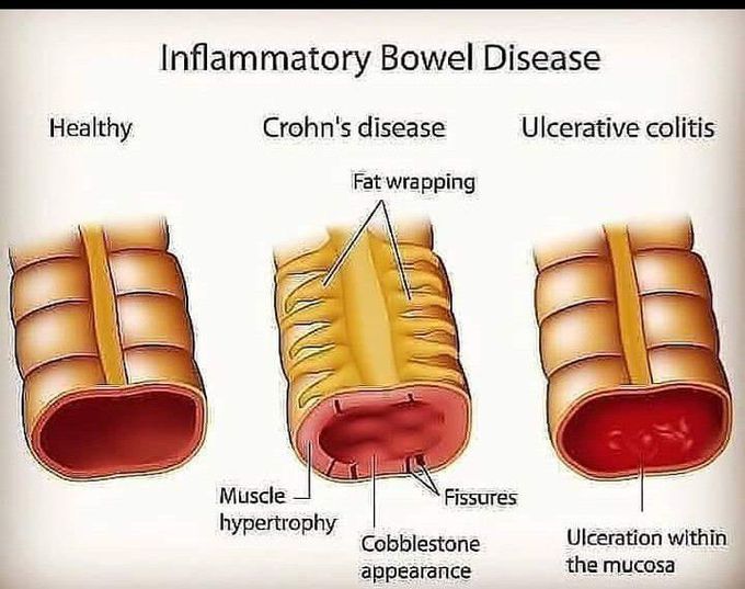 Inflammatory bowel disease