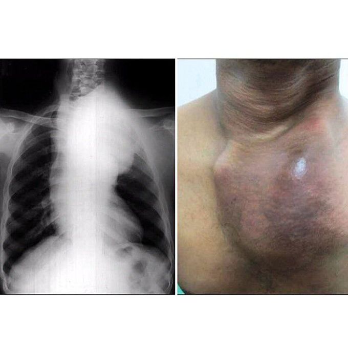 A case of Aortic Aneurysm due to syphilis infection