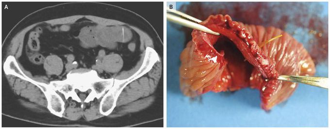 Fish Bone Perforation