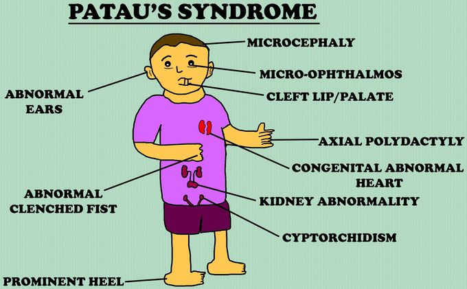 Patau syndrome physical characteristics