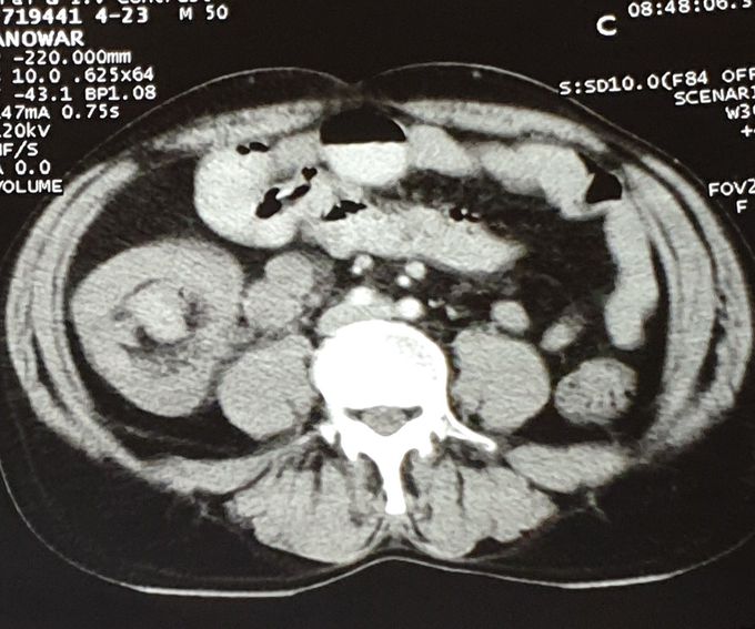 Intussusception