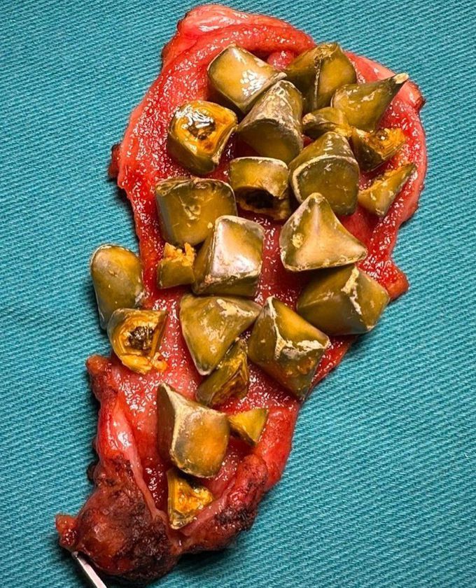 Gallstones