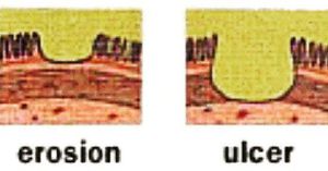 Erosion Vs Ulcer - MEDizzy