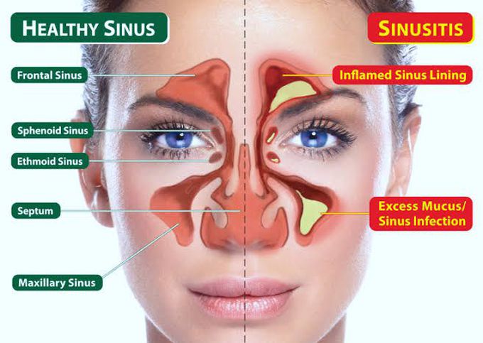 Sinusitis