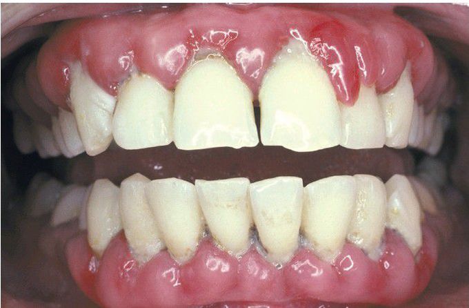 Chronic Hyperplastic Gingivitis