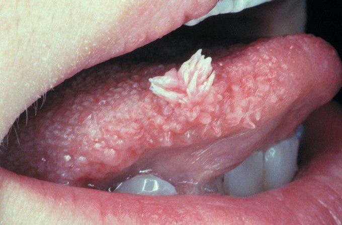 Squamous Papilloma.