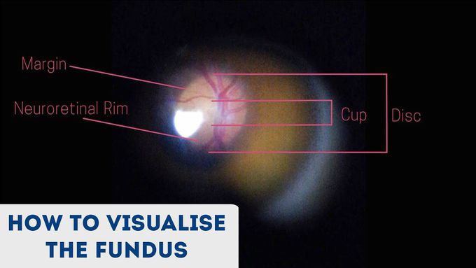 How to Visualise the Fundus | Direct Ophthalmoscopy
