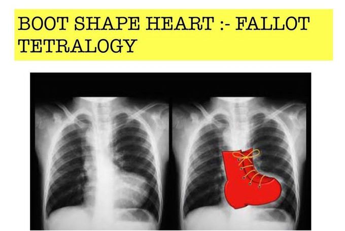 Fallot Teratology