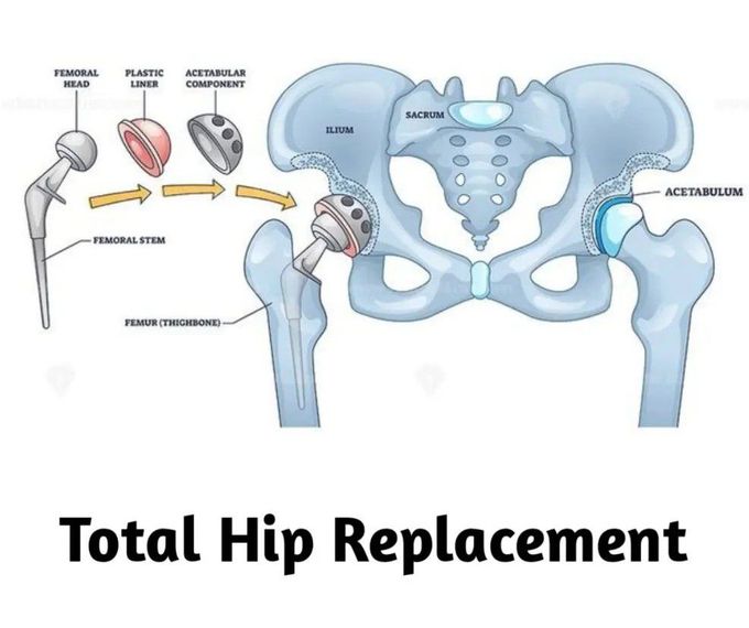 Total Hip Replacement