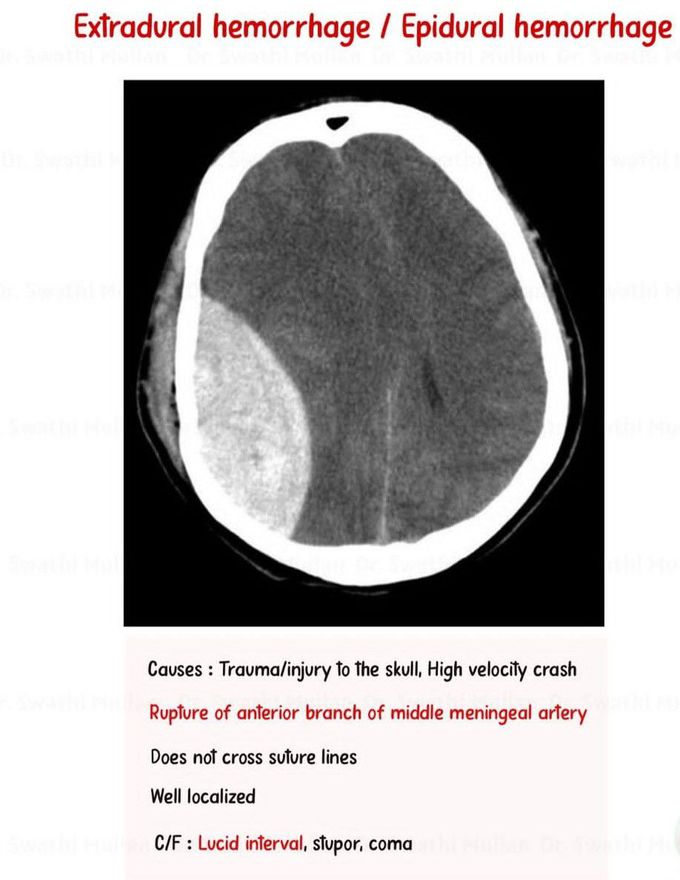 Epidural Hematoma