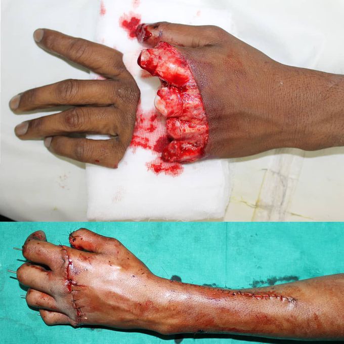 Finger amputation injury! 