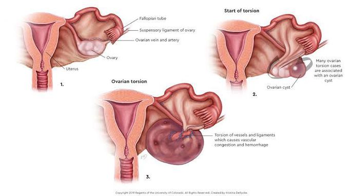 Ovarian torsion