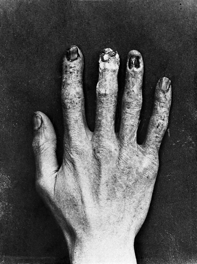 The hand of an early X-Ray technician, showing obvious radiation burns from the process required for calibration.