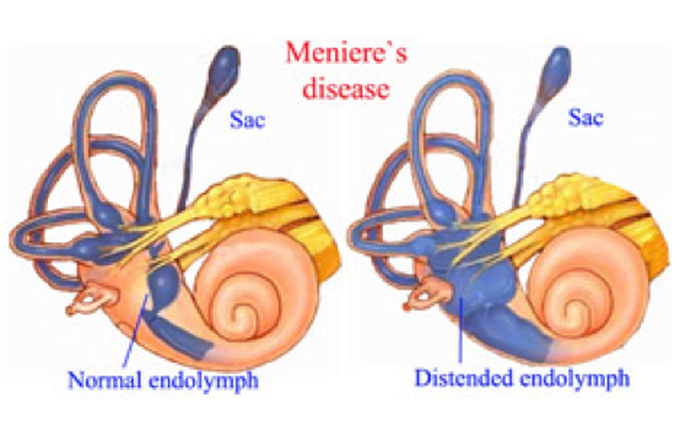 Ménière Disease