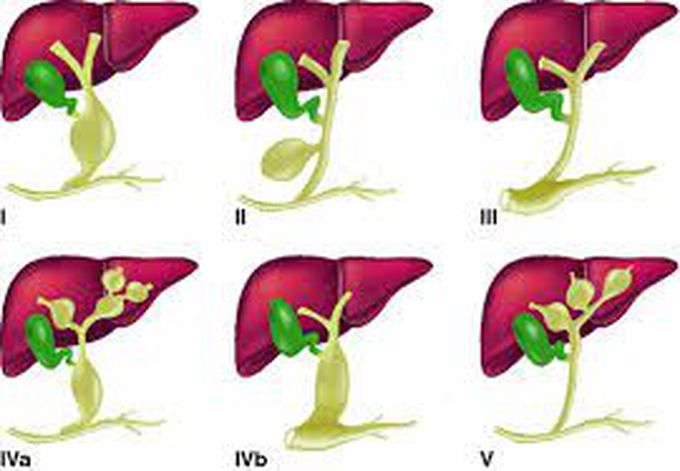 Choledochal cyst causes