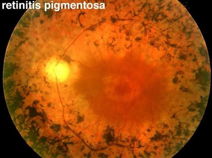 Fundus examination in case of retinitis pigmentosa