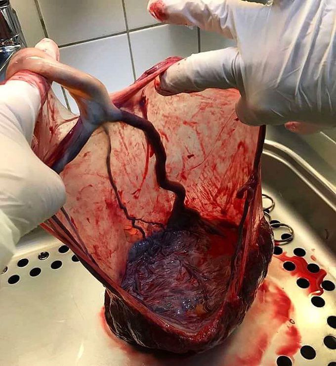 The placenta and umbilical cord removed shortly after delivery demonstrating a velamentous cord insertion!