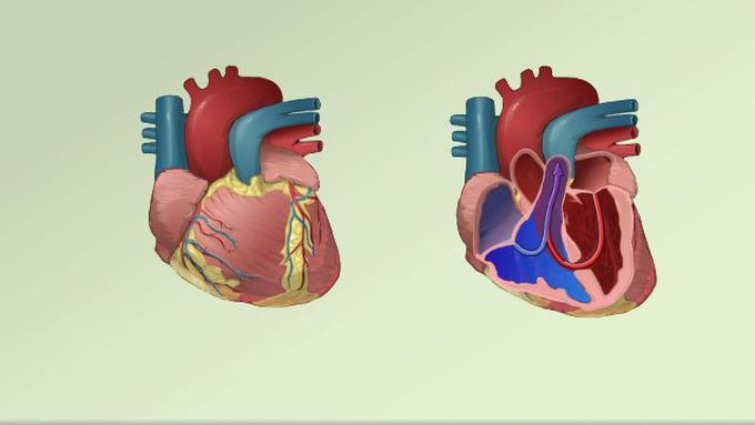 Treatment for Endocardial cushion