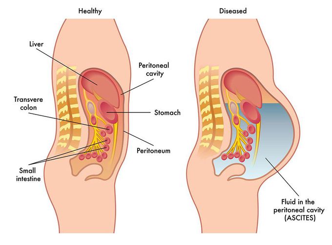 Ascites
