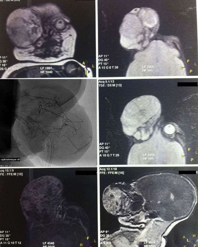 A Newborn with a Giant Teratoma!