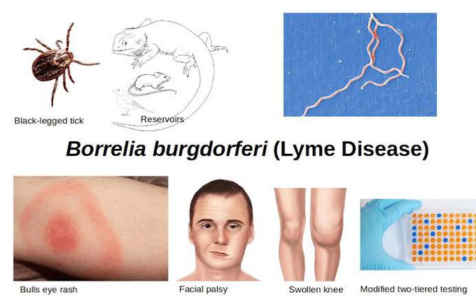 Lyme disease