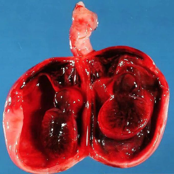 Testicular infarction by spermatic cord torsion