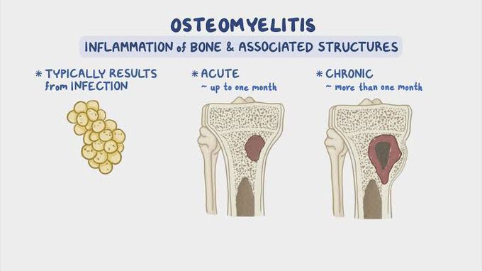 What is acute osteomyelitis