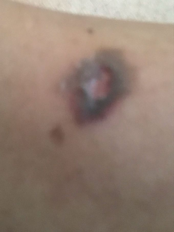 Skin lesion