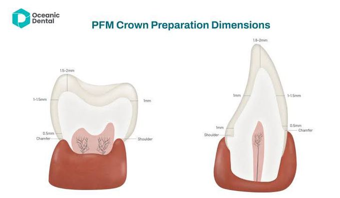 PFM Crown Preparation