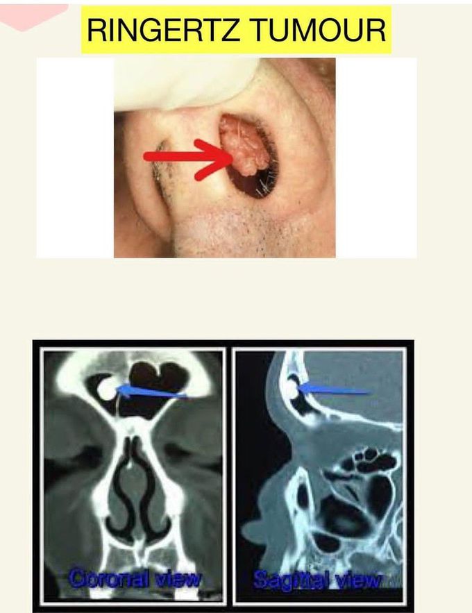 Ringertz Tumor