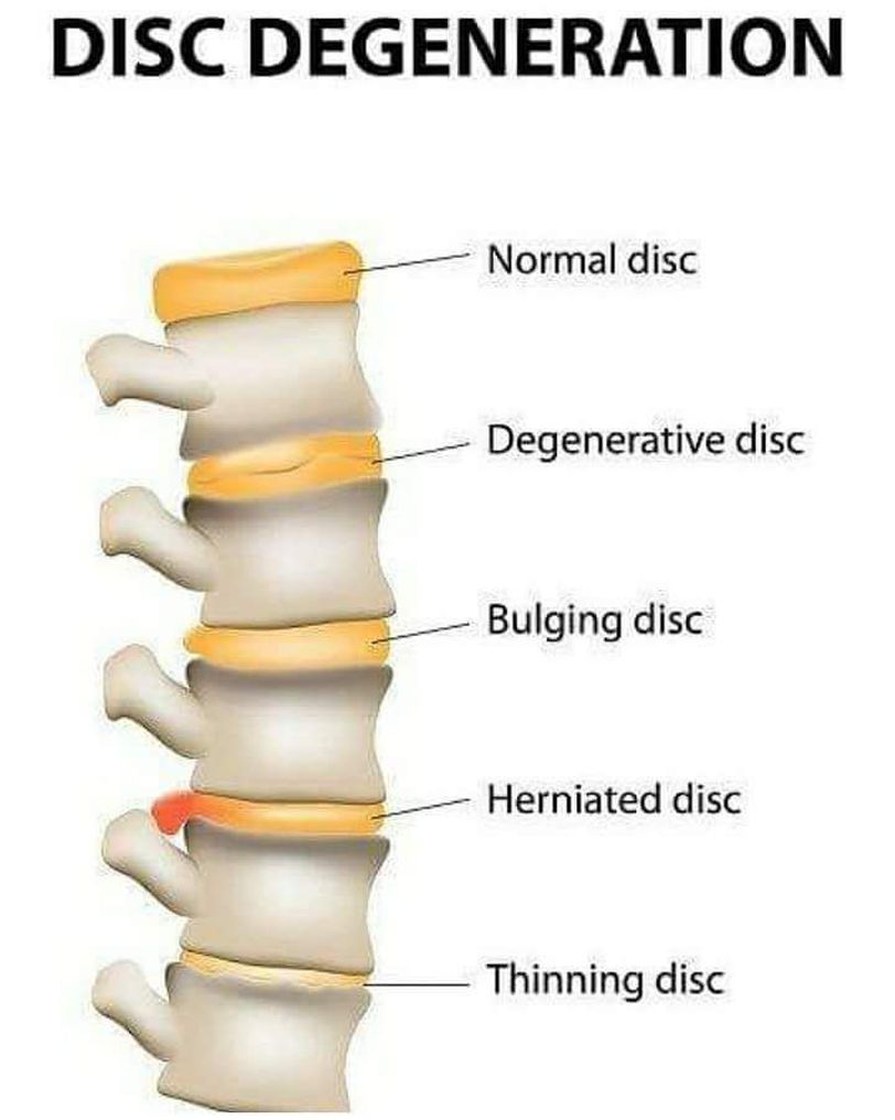 Disc degeneration - MEDizzy