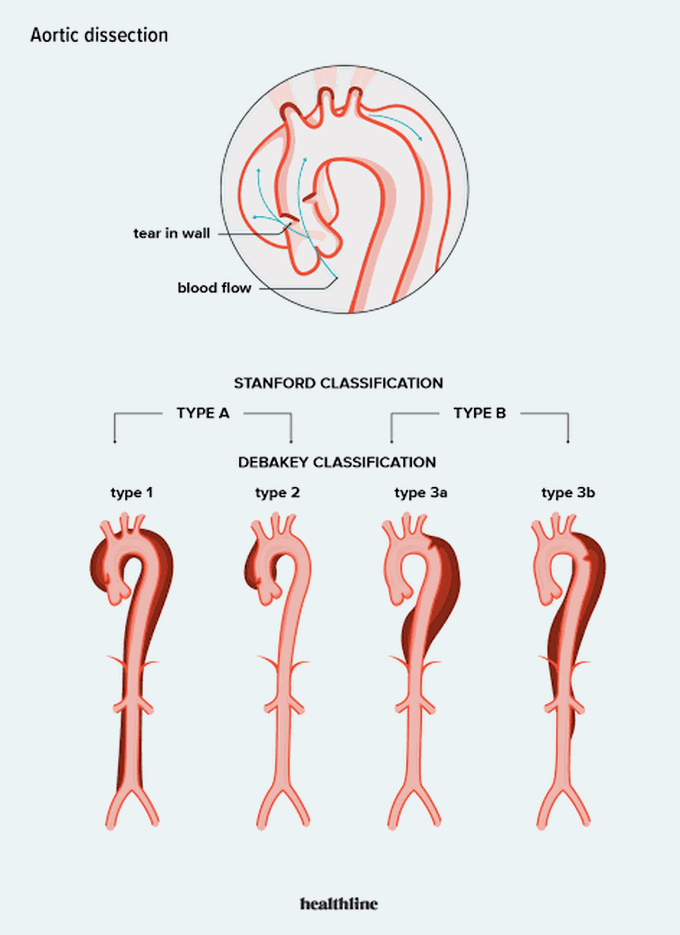 Aortic Dissection