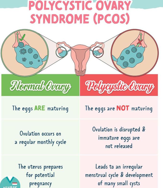 Polycystic Ovary Syndrome