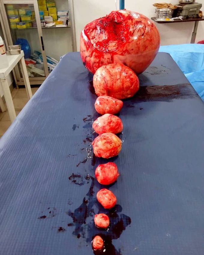 Uterine fibroids