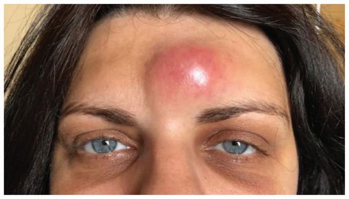Pott Puffy Tumor: A Complication of Sinusitis