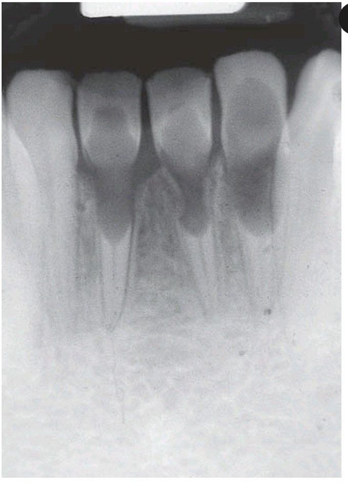 Internal resorption