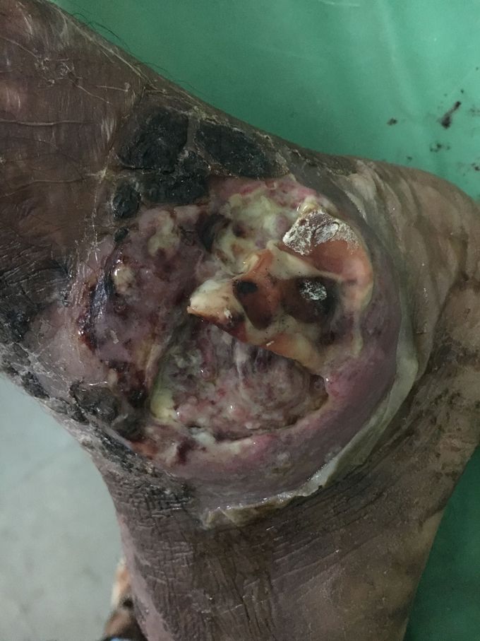 Non healing diabetic ulcer