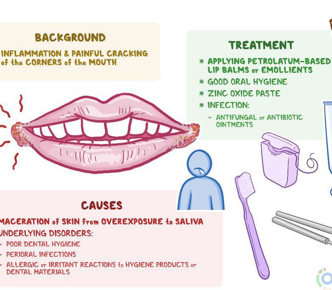 Causes of Angular cheilitis