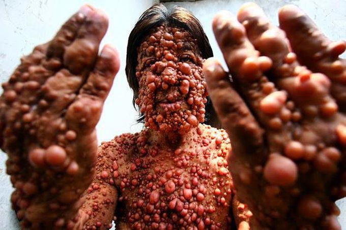 Trypophobia