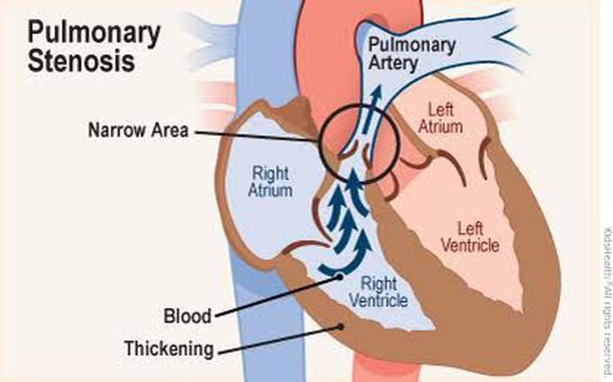 Complications of pulmonary stenosis